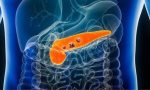 Crece la expectativa por un nuevo fármaco contra el cáncer de páncreas
